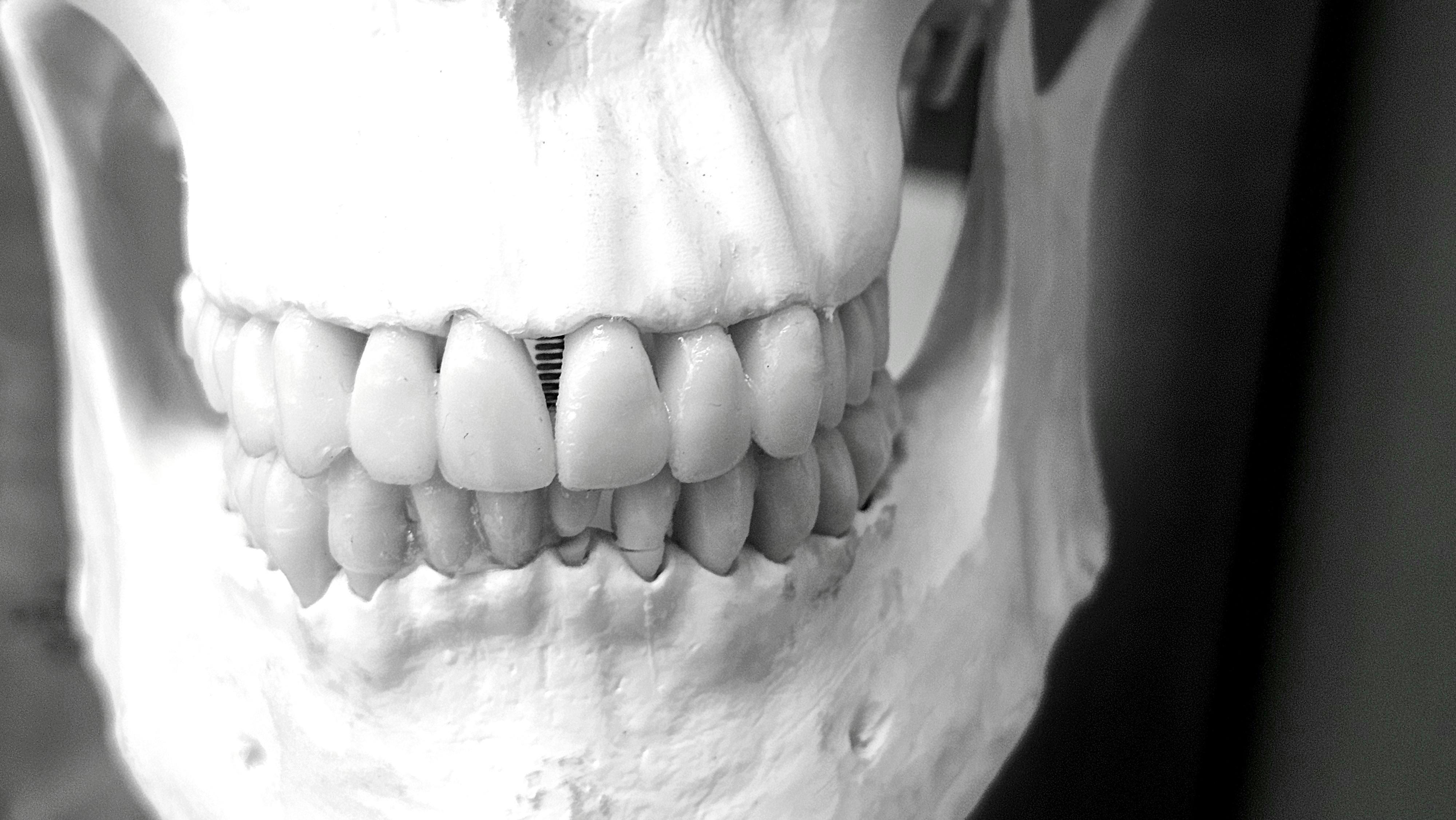 Facegenics Midface Expander (FME) device installed in a patient's palate