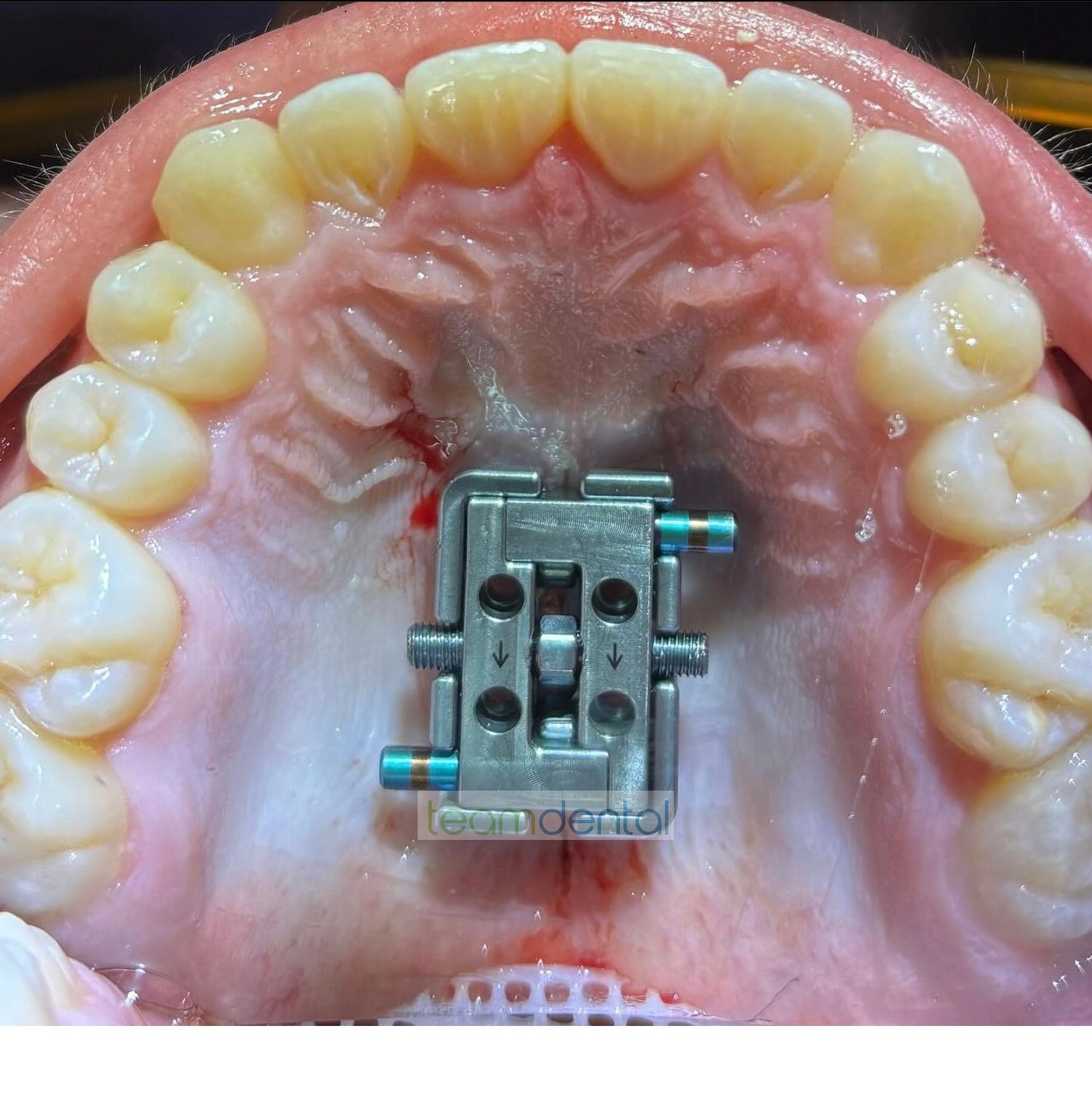 What Is the Facegenics Midface Expander (FME)? Full Review